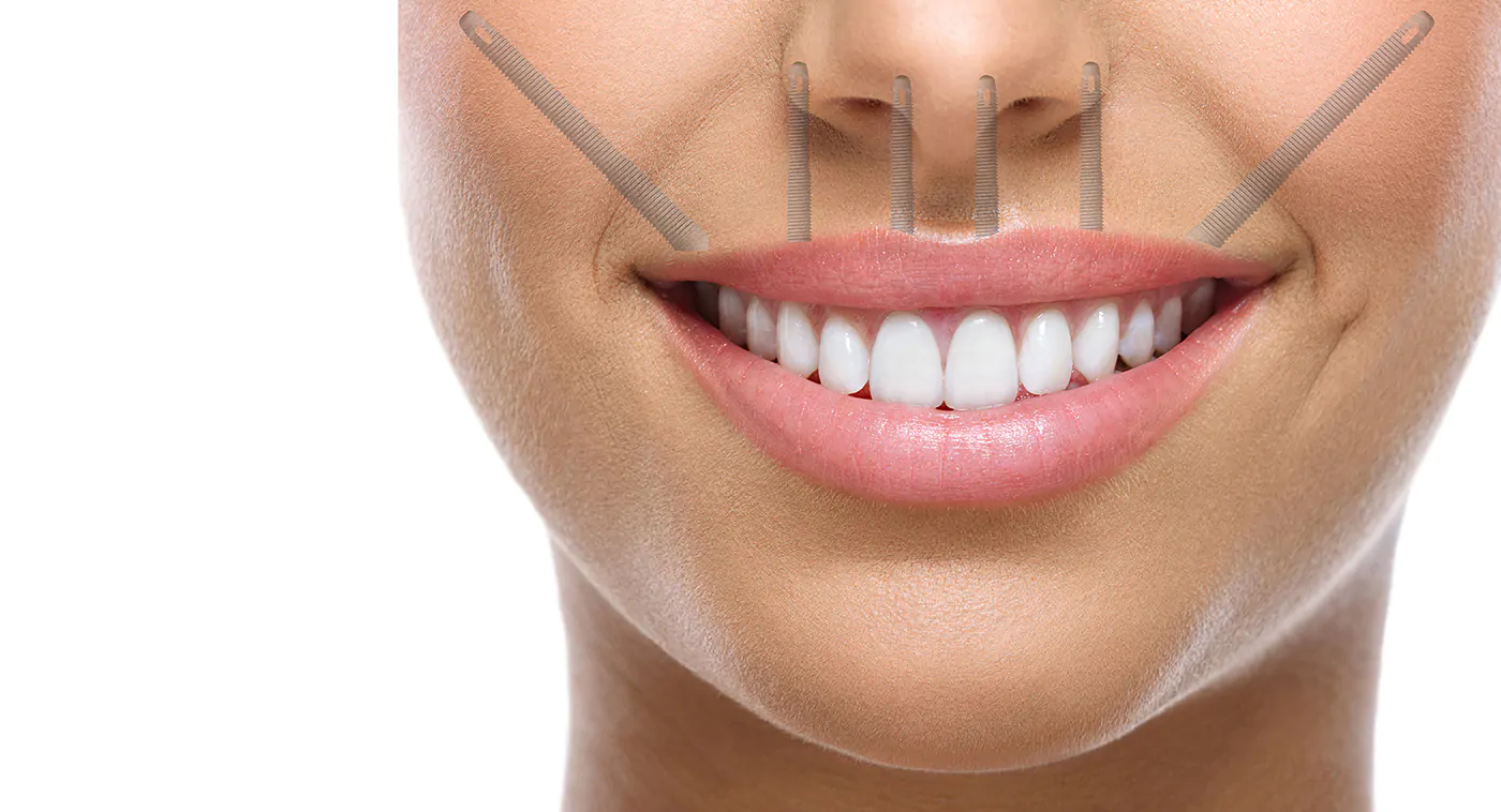 Zygoma Implant